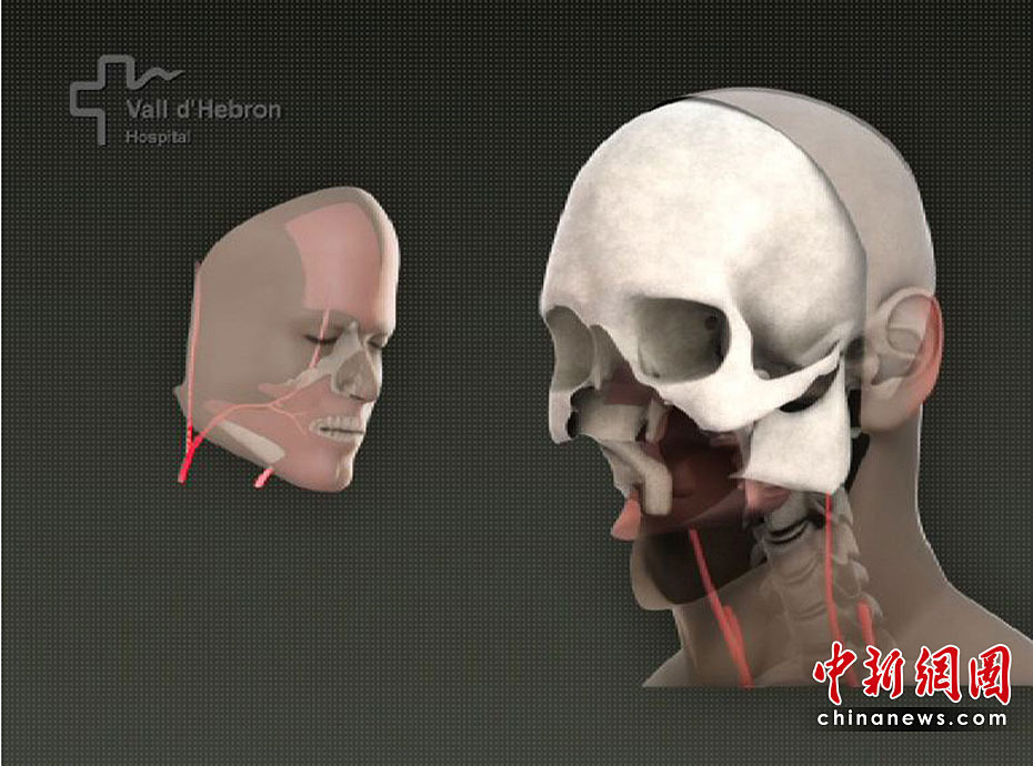 世界首例完整面部移植手术成功