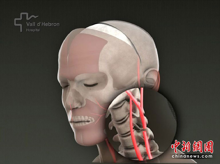 世界首例完整面部移植手术成功