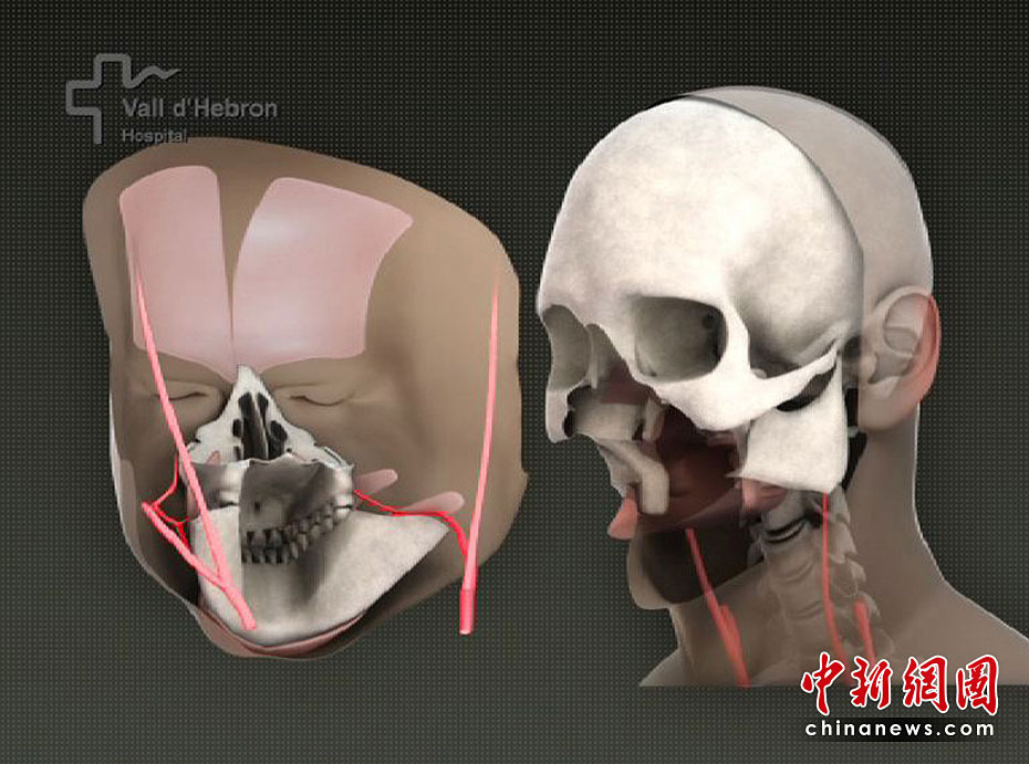 世界首例完整面部移植手术成功