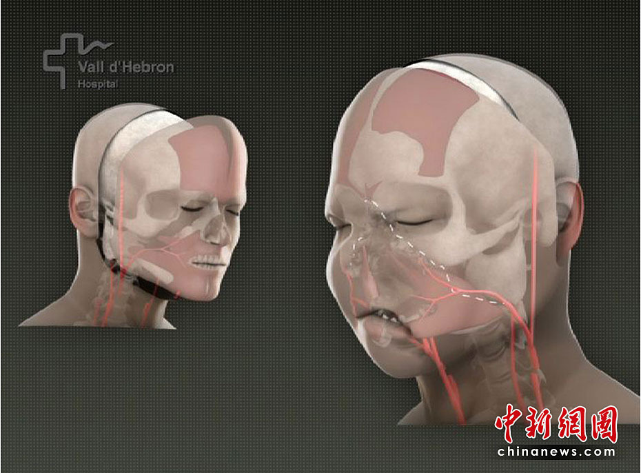 世界首例完整面部移植手术成功