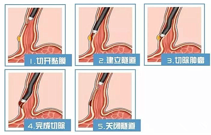 “镜”益求精，不开刀取肿瘤——神奇的STER