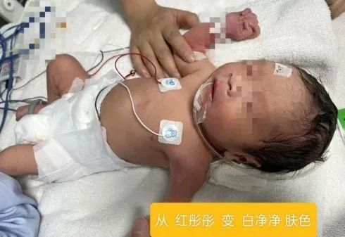 【卓越医疗】攸县人民医院新生儿科为早产儿成功实施首例换血术